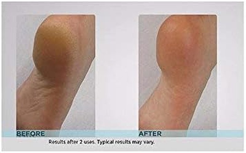 Emjoi Micro-Pedi Callus Remover - Effective Foot Care Tool w/Bonus Rollers | Turquoise
