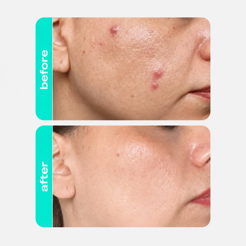 Creamy Salicylic Acid Toner | Anti-Acne Solution for Clear Skin | Effectively unclogs pores | Microbiota-Balancing Complex | Formulated for Sensitive Skin 3 Fl oz