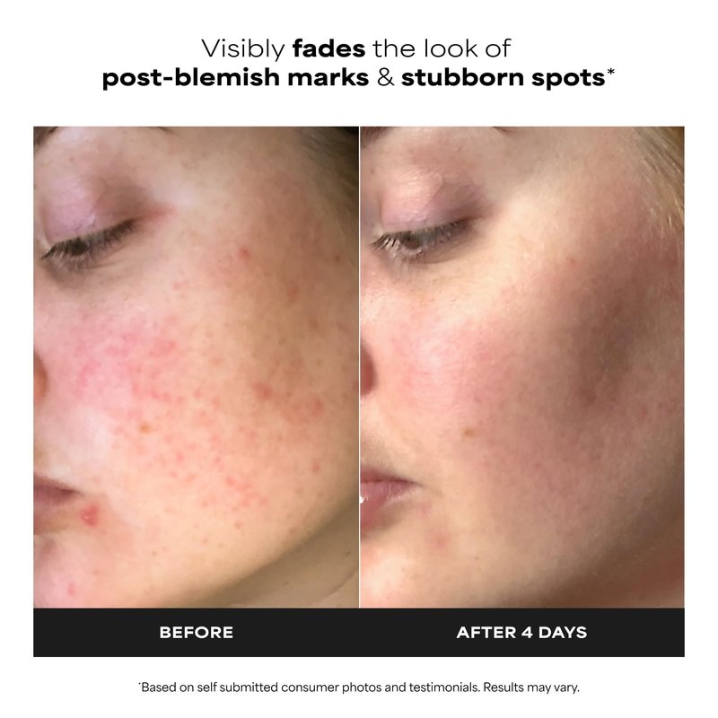 Paula’s Choice BOOST 10% Azelaic Acid Booster Cream Gel, Oil-Free Serum Fades Discoloration & Post-Blemish Marks, with Licorice Extract & Salicylic Acid, Fragrance-Free, 0.17 Fl Oz