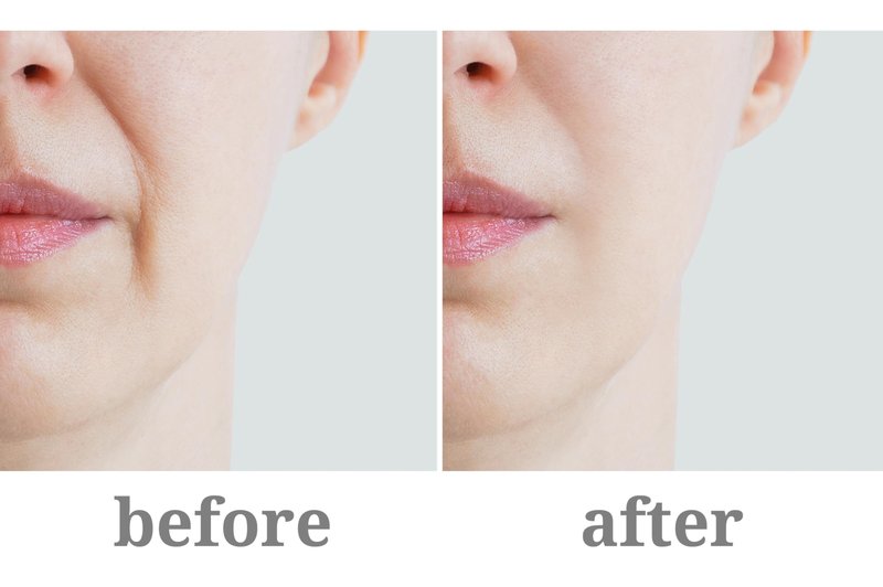 Vitality Precision Skin Retinol Peel Pads .5%- 3 month supply