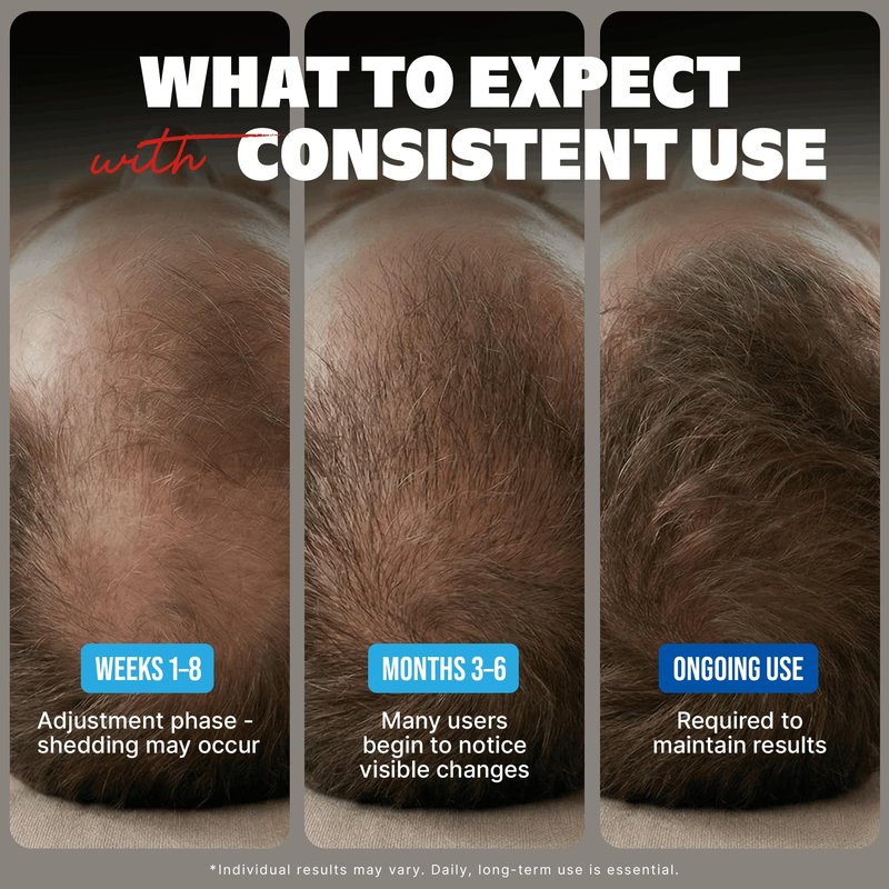 Kirkland Signature Minoxidil 5% Topical Solution for Men - 6 Month Supply (6 x 2 Fl Oz), Hair Regrowth Treatment with Dropper