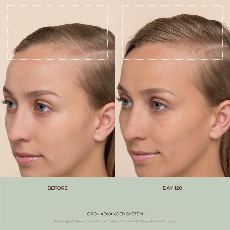 VEGAMOUR GRO+ Advanced Dermaroller | 1,200 Microneedle 0.25mm Scalp Tool | Gently Exfoliates the Scalp | Wide Head for Maximum Coverage