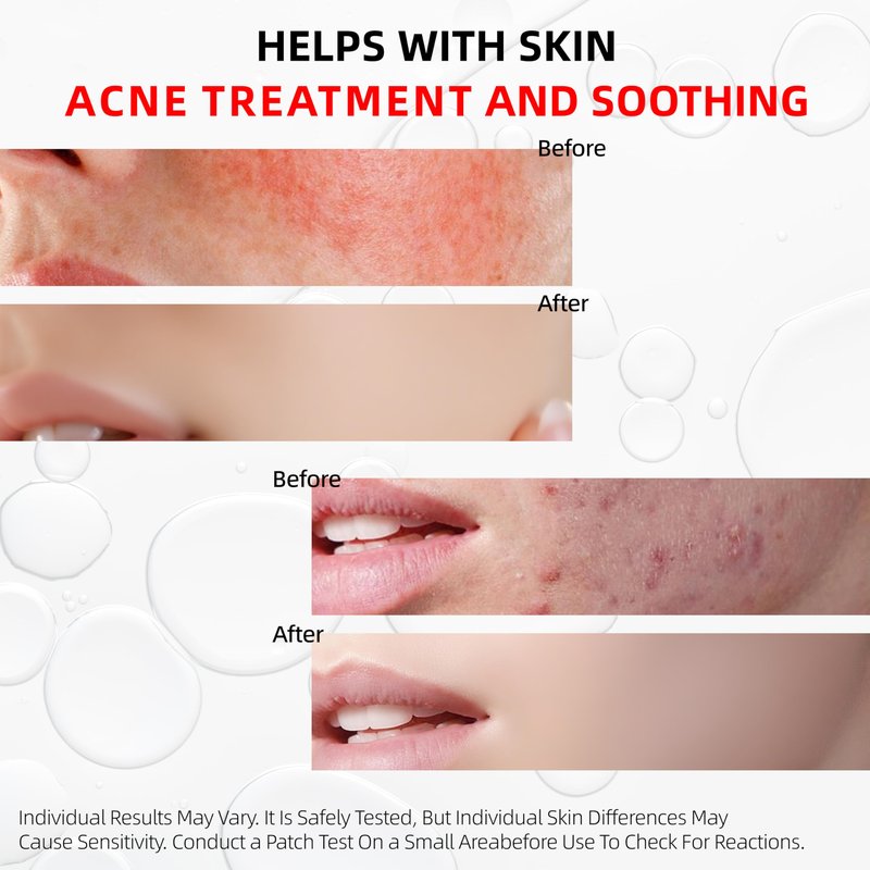 HKY Acne Serum, Salicylic Acid (BHA) + PHA + PAD, Redness Relief in 90 Mins, OTC Formula with Rice Ferment & Centella & Niacinamide, Pore Minimizer & Post-Acne Mark Treatment, Acne-Prone Skin [20ml]