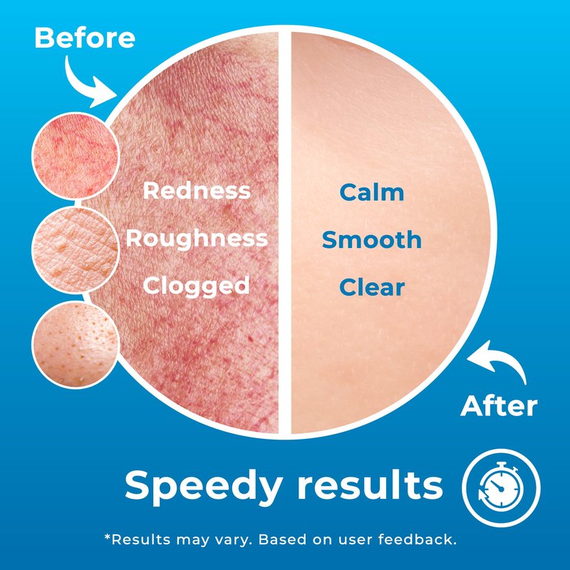 PatchRx Hypochlorous Acid Spray (8oz, 2 packs), HOCL Facial Cleanser Acne Spray for Face, Body, Eczema, Pimples, Breakouts & Overall Skin Recovery (Reduces Redness)